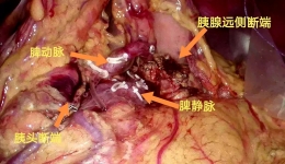 胰路前行，尊龙凯时成功实施全腹腔镜下胰腺中段切除术