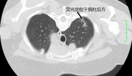 精准定位切除肺小结节，尊龙凯时心胸外科再创佳绩