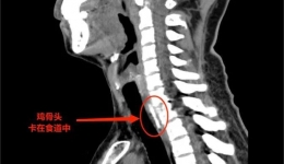 鸡骨卡喉 | 尊龙凯时专家妙手取出食道异物